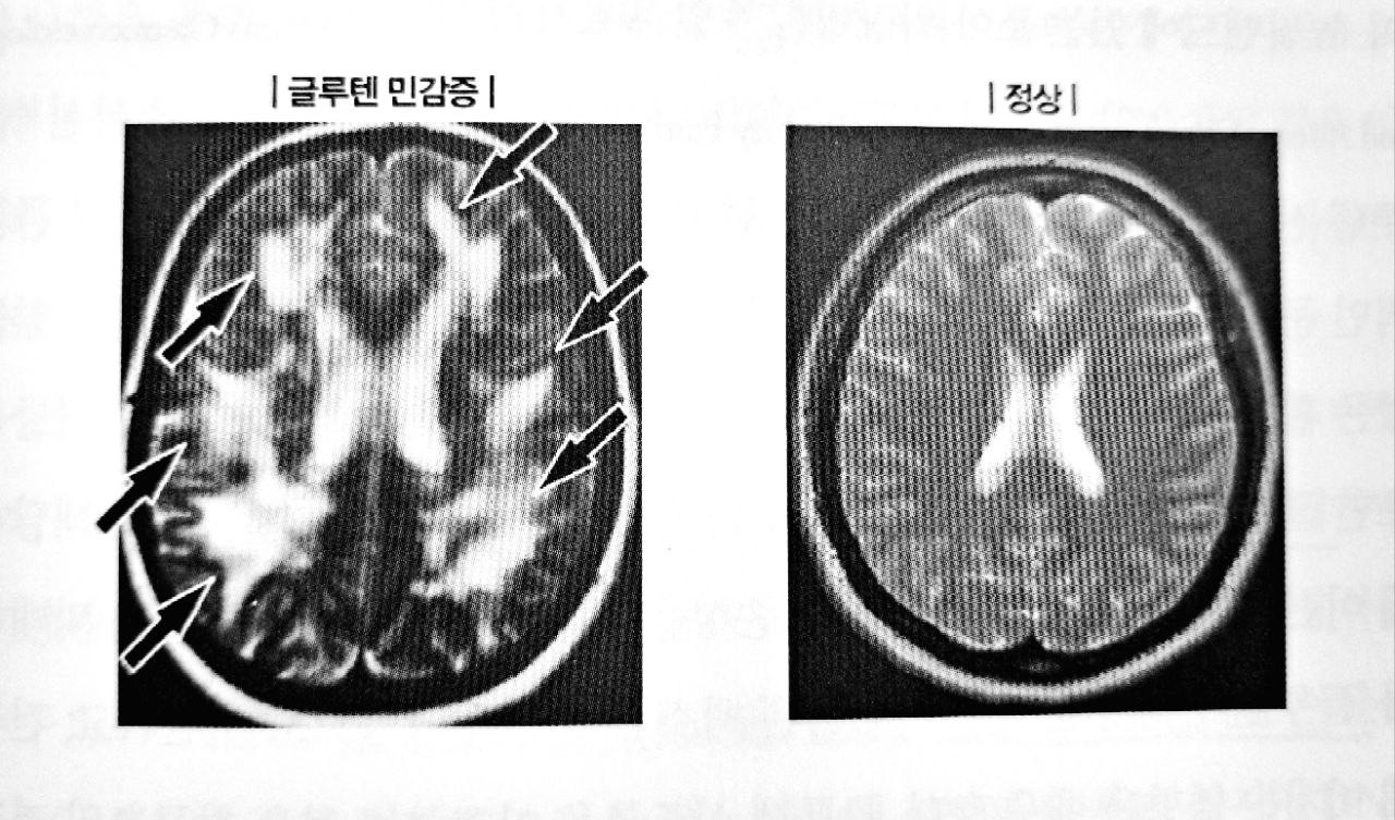 글루텐뇌